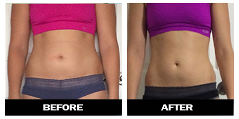 before and after fat freezing system image